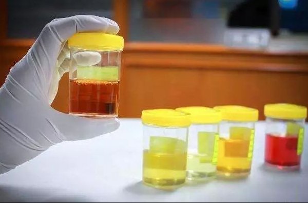 尿黑酸尿症 (AKU)图片